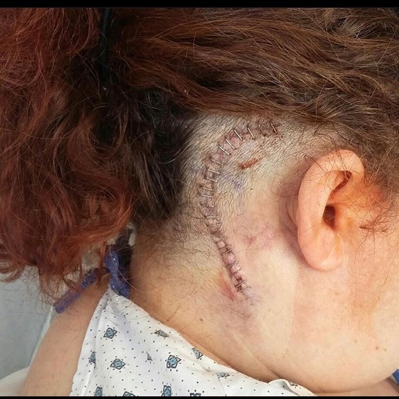 Hi Melanie-Trigeminal Neuralgia / Brain Surgery - Picture 1 of 6